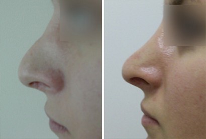 Устранение горбинки носа